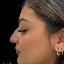 Liquid Rhinoplasty(Non-Surgical) Before & After Patient #19337