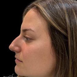 Liquid Rhinoplasty(Non-Surgical) Before & After Patient #19318