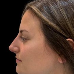 Liquid Rhinoplasty(Non-Surgical) Before & After Patient #19318