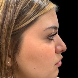 Liquid Rhinoplasty(Non-Surgical) Before & After Patient #19338