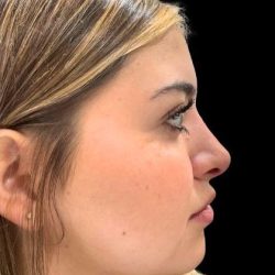 Liquid Rhinoplasty(Non-Surgical) Before & After Patient #19338
