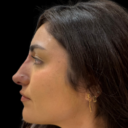 Liquid Rhinoplasty(Non-Surgical) Before & After Patient #19396