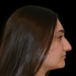 Rhinoplasty Before & After Patient #19427