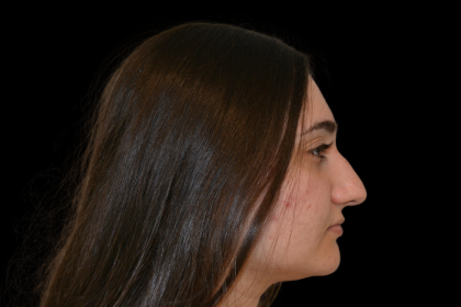 Rhinoplasty Before & After Patient #19427