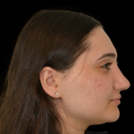 Rhinoplasty Before & After Patient #19427