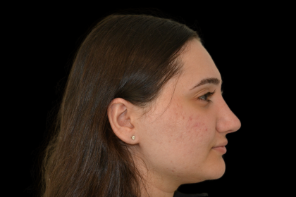Rhinoplasty Before & After Patient #19427