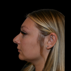 Rhinoplasty Before & After Patient #19441
