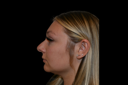 Rhinoplasty Before & After Patient #19441