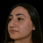 Rhinoplasty Before & After Patient #19427
