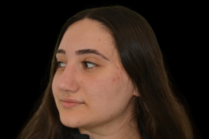 Rhinoplasty Before & After Patient #19427