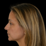 Rhinoplasty Before & After Patient #19448