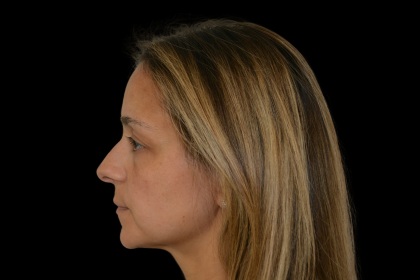Rhinoplasty Before & After Patient #19448