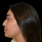 Rhinoplasty Before & After Patient #19455