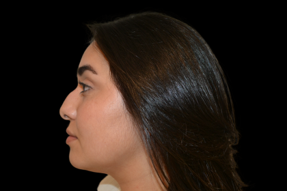 Rhinoplasty Before & After Patient #19455