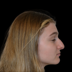 Rhinoplasty Before & After Patient #19462