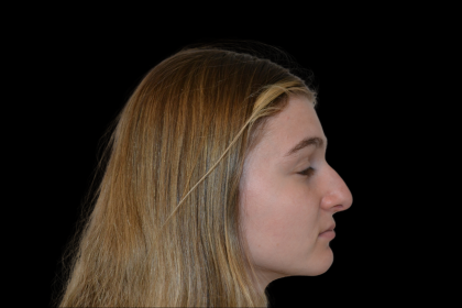 Rhinoplasty Before & After Patient #19462