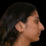 Rhinoplasty Before & After Patient #19428
