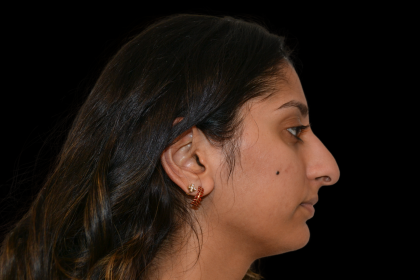 Rhinoplasty Before & After Patient #19428