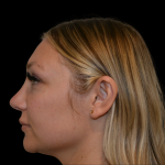 Rhinoplasty Before & After Patient #19441