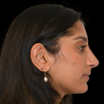 Rhinoplasty Before & After Patient #19428