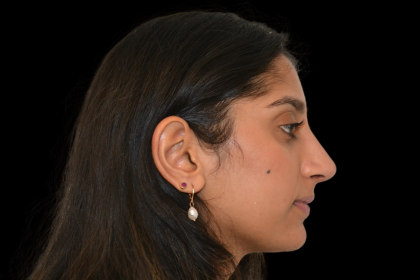 Rhinoplasty Before & After Patient #19428