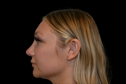 Rhinoplasty Before & After Patient #19441