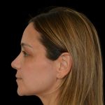 Rhinoplasty Before & After Patient #19448