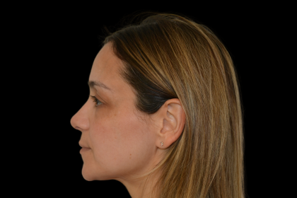 Rhinoplasty Before & After Patient #19448
