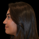 Rhinoplasty Before & After Patient #19455