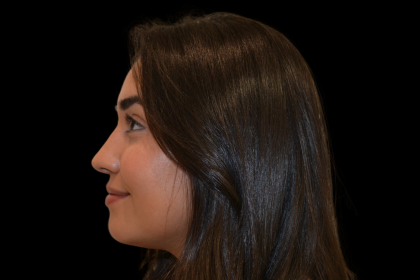 Rhinoplasty Before & After Patient #19455
