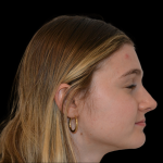Rhinoplasty Before & After Patient #19462