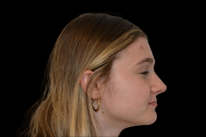Rhinoplasty Before & After Patient #19462