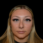Rhinoplasty Before & After Patient #19441