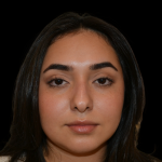 Rhinoplasty Before & After Patient #19455