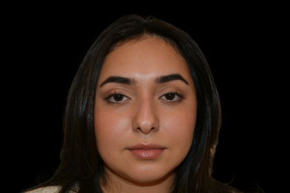 Rhinoplasty Before & After Patient #19455
