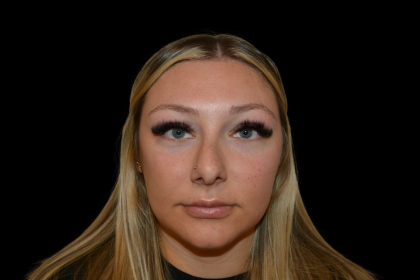 Rhinoplasty Before & After Patient #19441