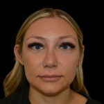 Rhinoplasty Before & After Patient #19441