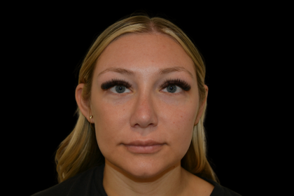 Rhinoplasty Before & After Patient #19441