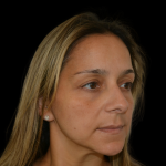 Rhinoplasty Before & After Patient #19448