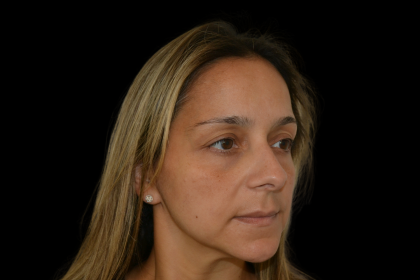 Rhinoplasty Before & After Patient #19448