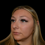 Rhinoplasty Before & After Patient #19441