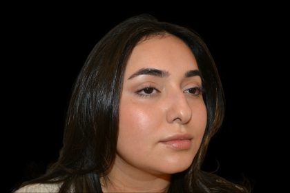 Rhinoplasty Before & After Patient #19455