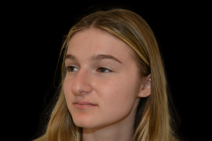 Rhinoplasty Before & After Patient #19462