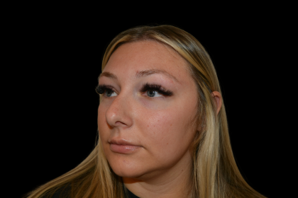 Rhinoplasty Before & After Patient #19441