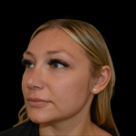 Rhinoplasty Before & After Patient #19441