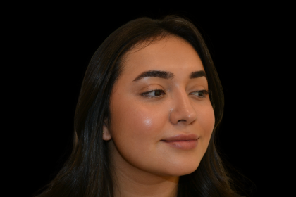 Rhinoplasty Before & After Patient #19455