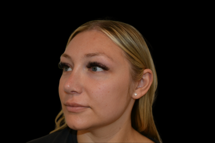 Rhinoplasty Before & After Patient #19441
