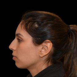Rhinoplasty Before & After Patient #19535