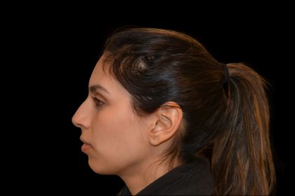 Rhinoplasty Before & After Patient #19535