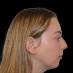 Rhinoplasty Before & After Patient #19537